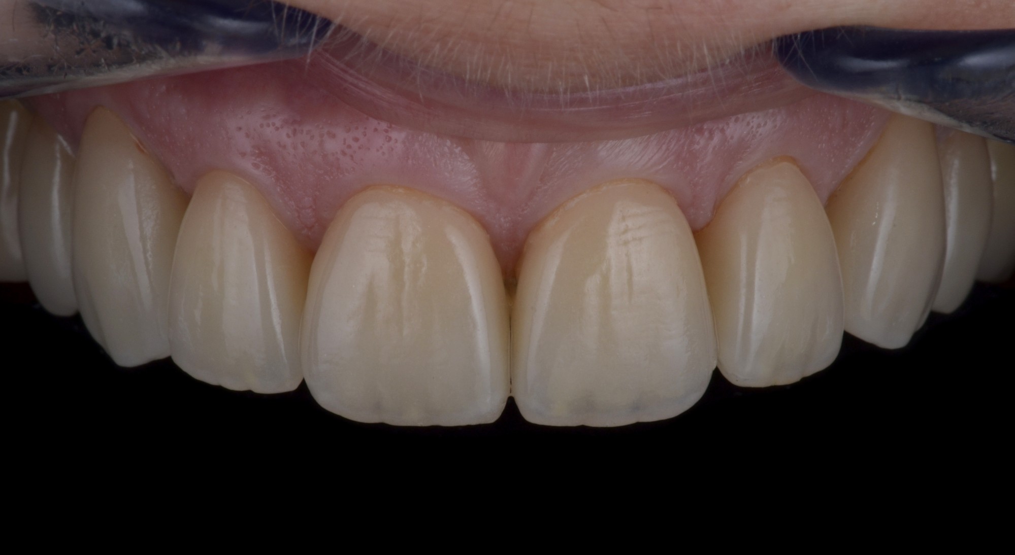 Réhabilitation esthétique avec soucis BIOMIMETIQUE (Dr Lugari-Aubagne 13) Parution « Prothèse Dentaire Française » Octobre 2015