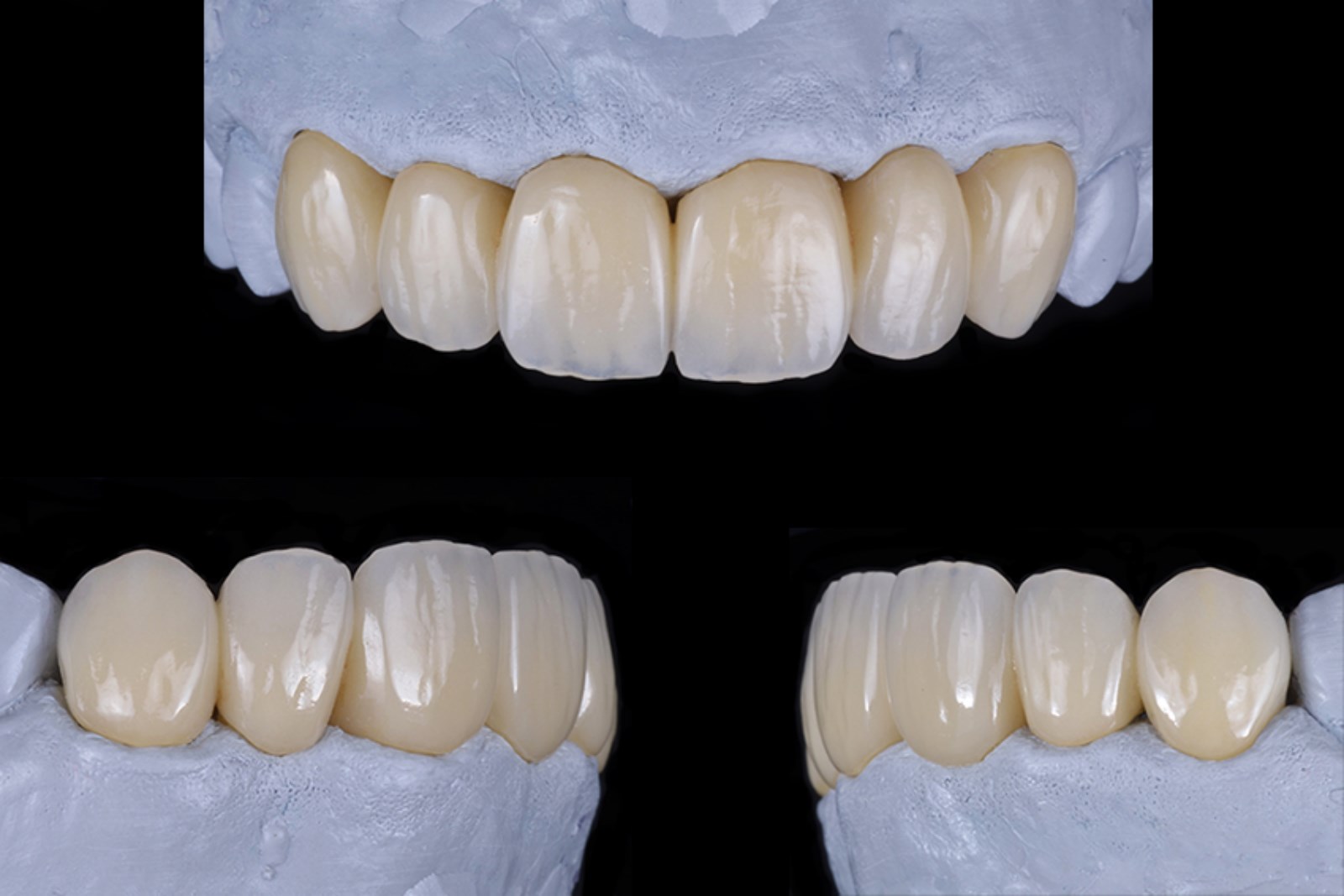 Bridge anterieur maxillaire surpressé…Parution ‘Prothèse Dentaire Française’ Mai/juin 2015 ( Dr Monleau J-d / Vitrolles)